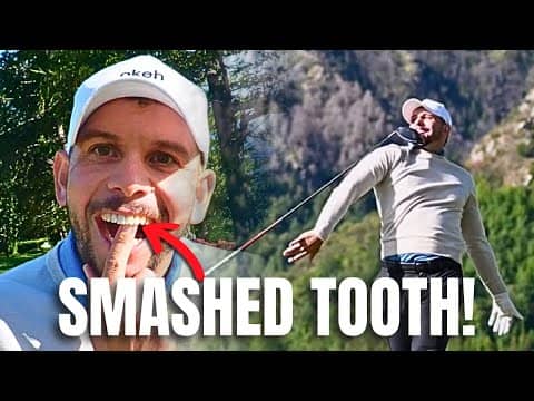 I SMASHED My Tooth